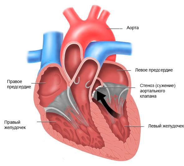 аортальный стеноз